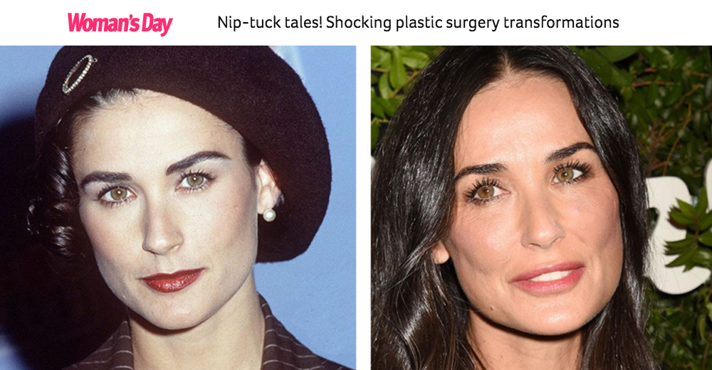 Women's Day feature - Nip-tuck tales! Shocking plastic surgery transformations