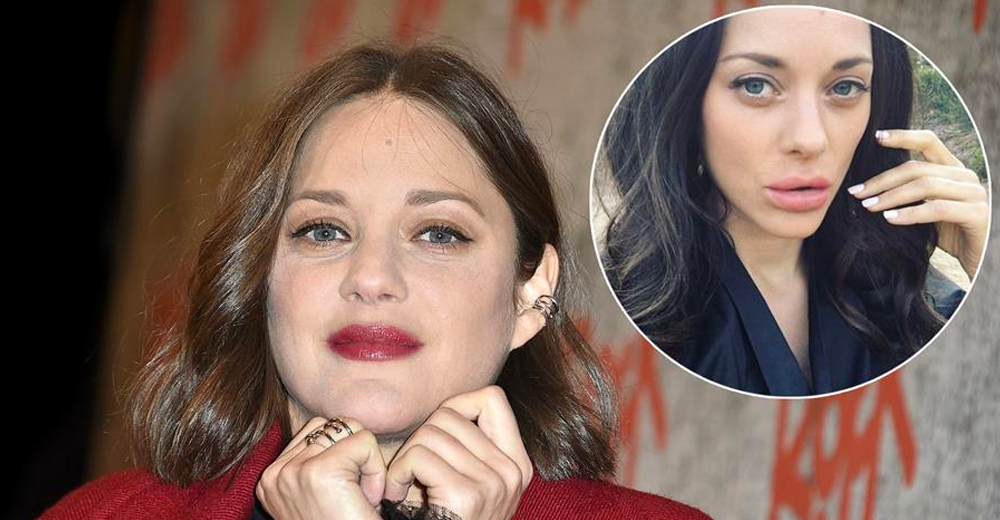 Dr JSK in the media : Marion Cotillard's lips have rattled the internet