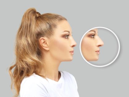 Rhinoplasty (Nose Job)